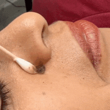 Luminiix Eliminador De Verrugas